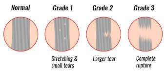 GRADE 2 MCL SPRAIN