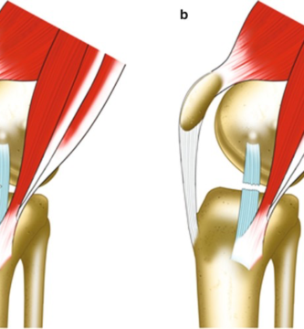 Long-Term MCL Effects