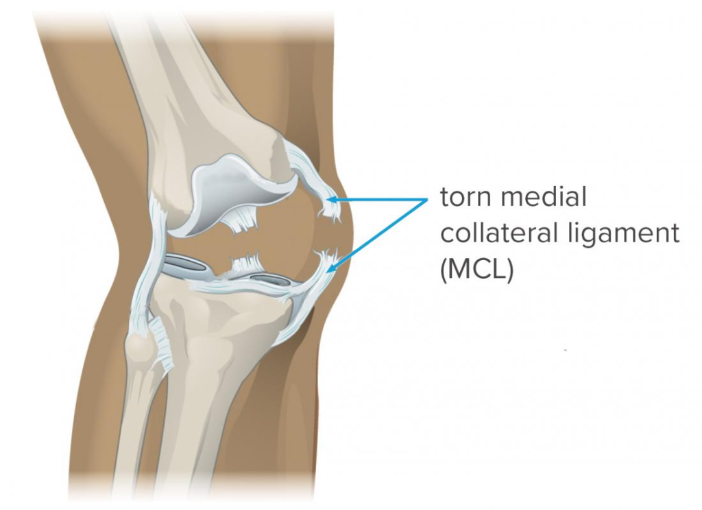 MCL Injury Complications