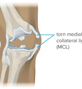 MCL Injury Complications