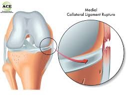SEVERE MCL INJURY