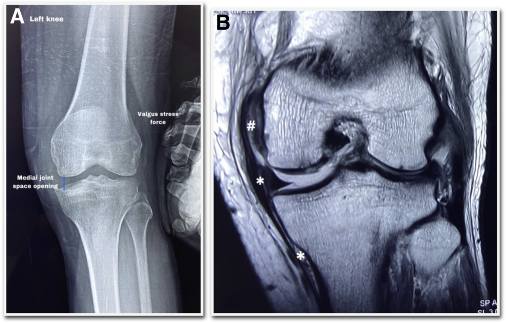 chronic mcl instability