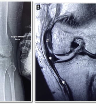 chronic mcl instability