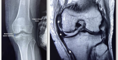 chronic mcl instability