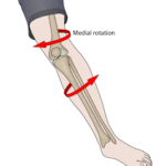 knee twisting injury