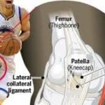 basketball mcl tears