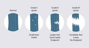 mcl tear classification