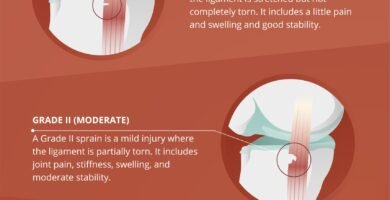 how to deal with MCL Sprain Treatment