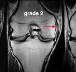 is mri needed for mcl sprain diagnosis