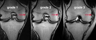 is mri needed for mcl sprain diagnosis