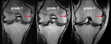 is mri needed for mcl sprain diagnosis