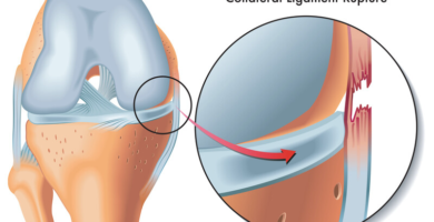 medial collateral ligament