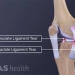 mcl injury causes