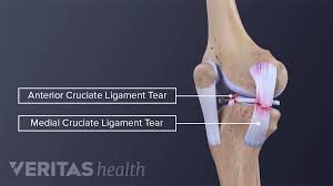 mcl injury causes