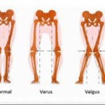Valgus Force Knee
