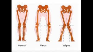 Valgus Force Knee