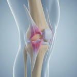 What are long-term effects of MCL sprain?