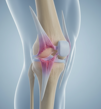 What are long-term effects of MCL sprain?
