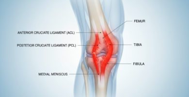 What is the fastest way to heal MCL sprain?